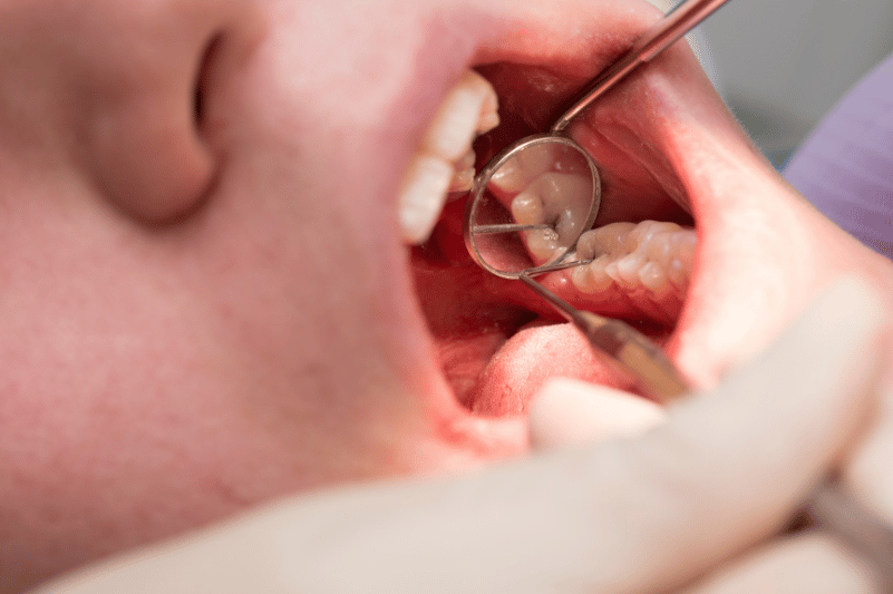 Cómo prevenir caries